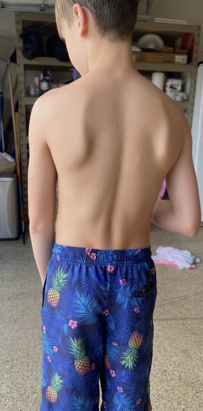 Before: Skin & Bones / Age 14